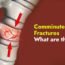 Comminuted Fracture