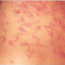 Ivermectin 40 mg: Advanced Defense Against Infestations